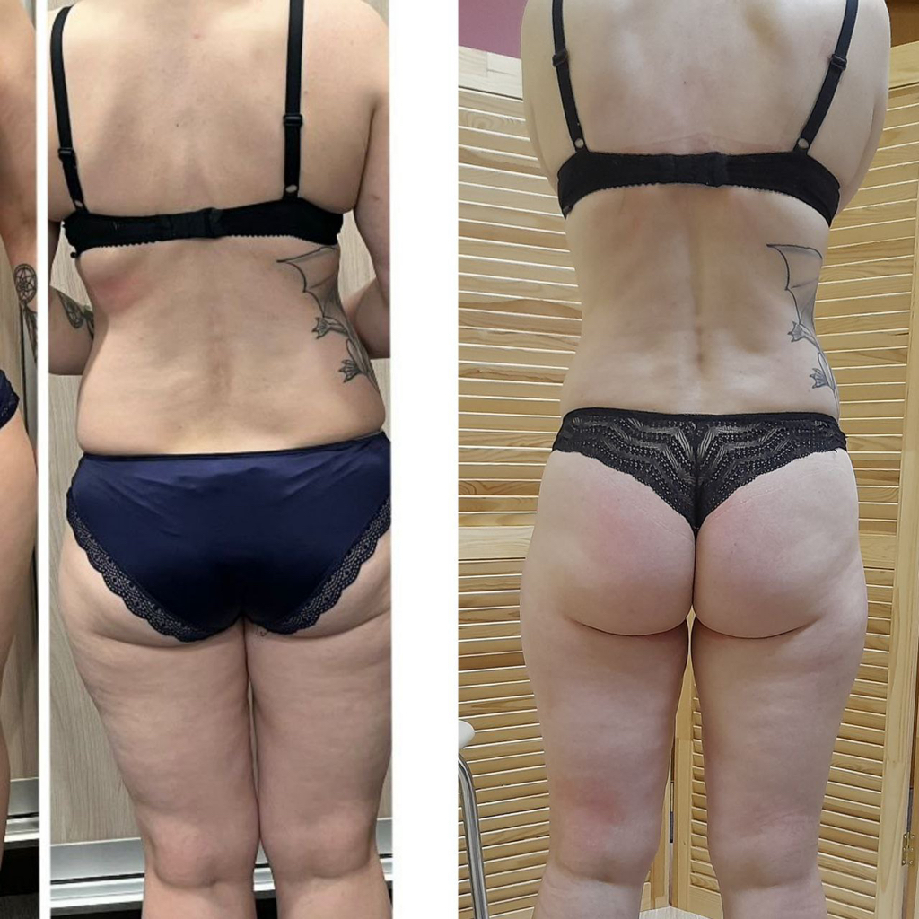 Антицеллюлитный массаж