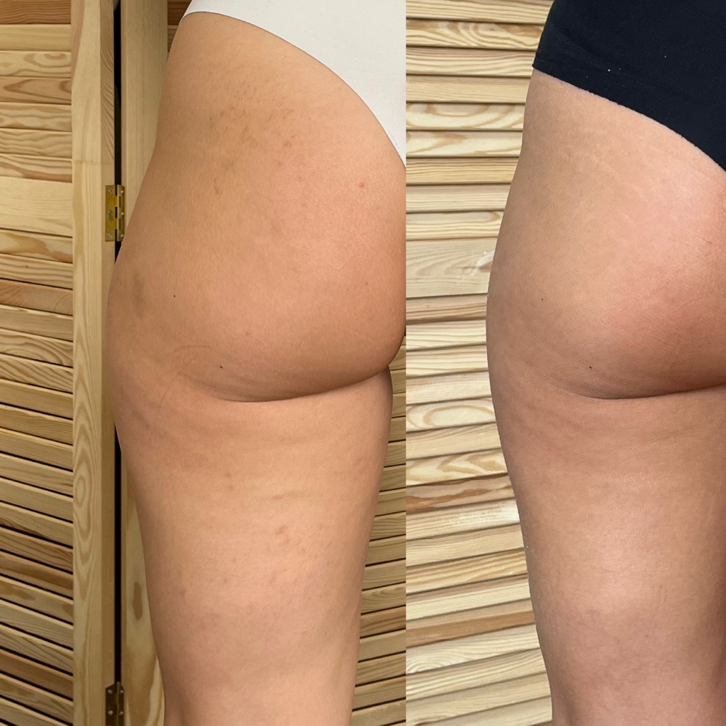 Скульптурный массаж по зонам ( галифе, внутренняя и задняя поверхность бедер, живот, бока, икры, руки), 1 зона - 1 сеанс.