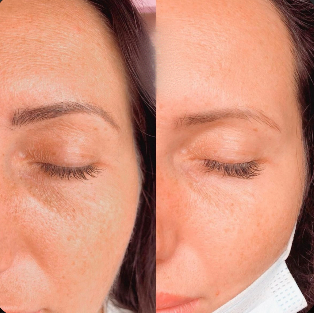 Удаление старого татуажа лазером/ ремувером