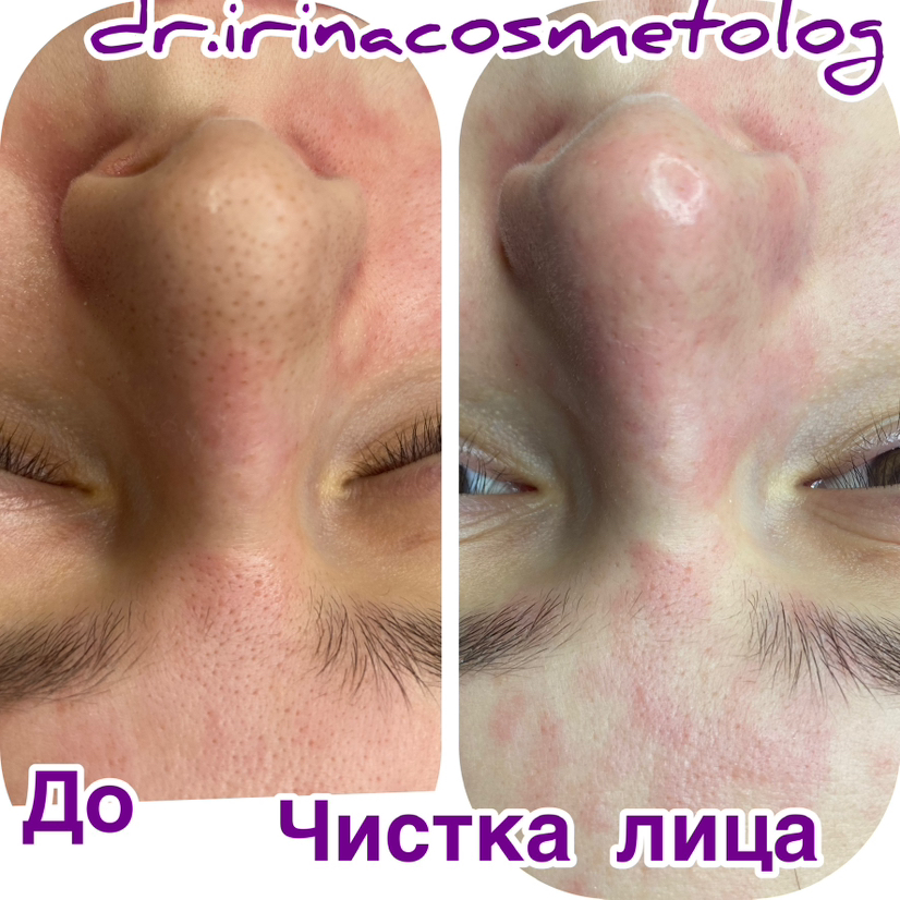 Чистка лица- делает  Ирина