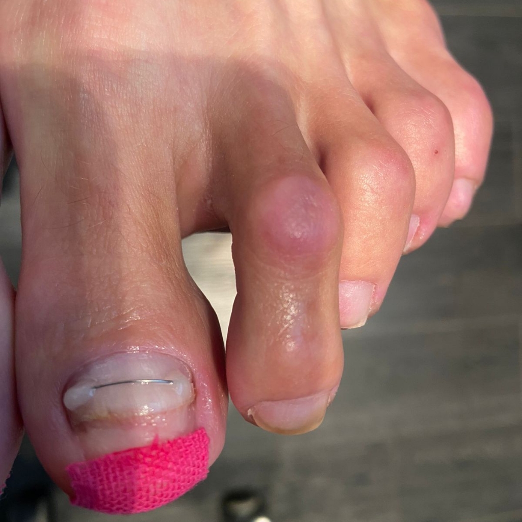 Установка титановой нити на 1 ноготь