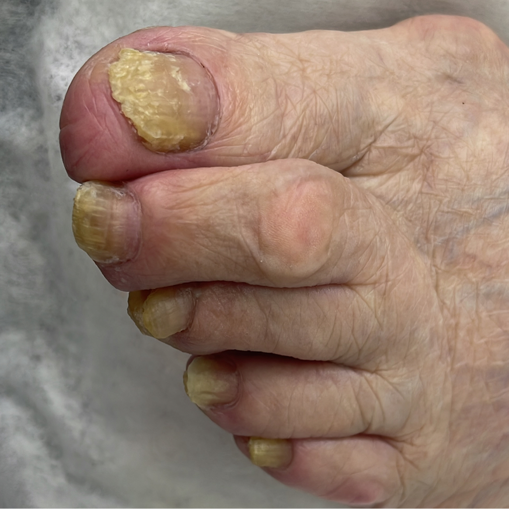 Медицинский педикюр (обработка проблемных ног)