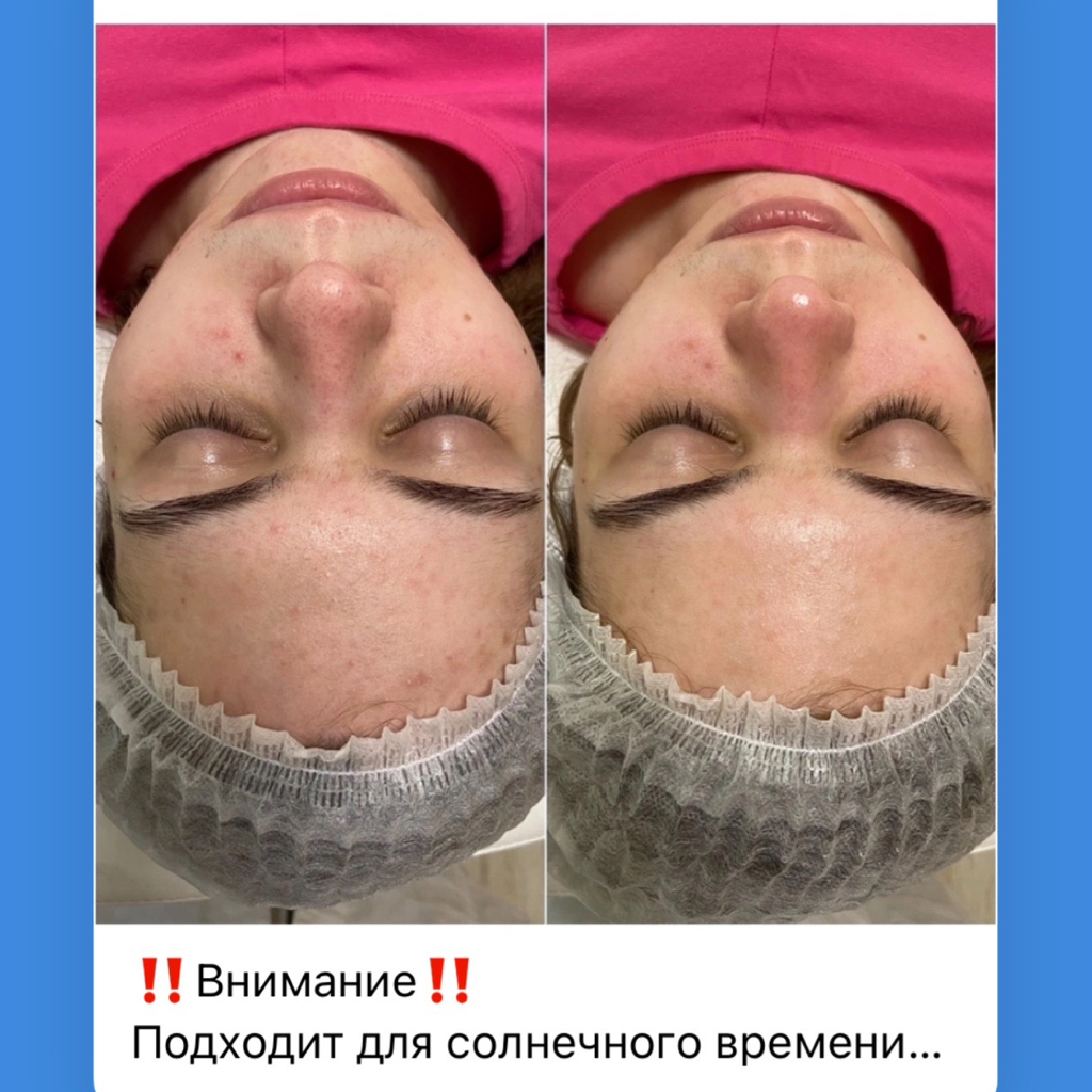 ВАКУУМНАЯ ЧИСТКА ЛИЦА