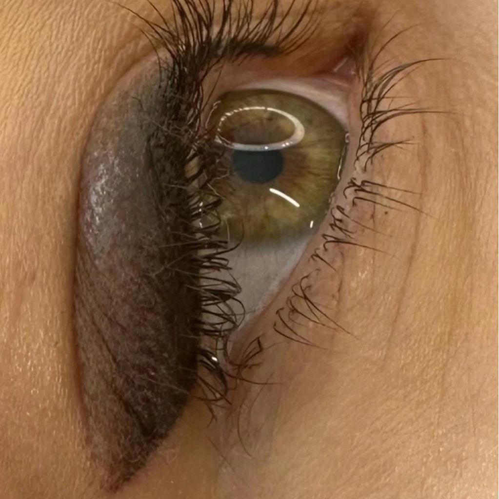 Стрелки первичная процедура