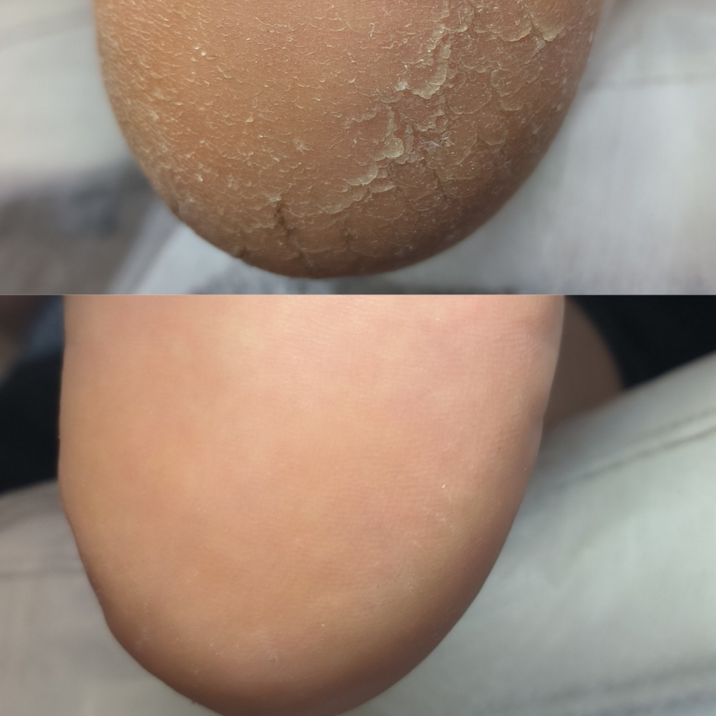 Педикюр Аппаратный