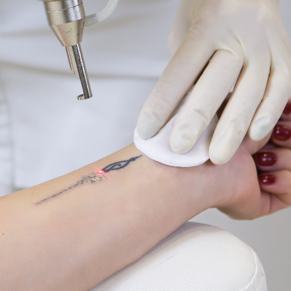 Лазерное удаление татуировок