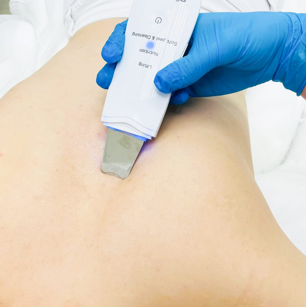 Комбинированная чистка спины (Израиль)