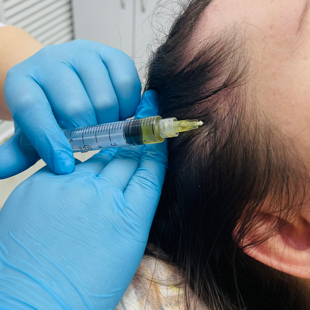 Мезотерапия волосистой части головы