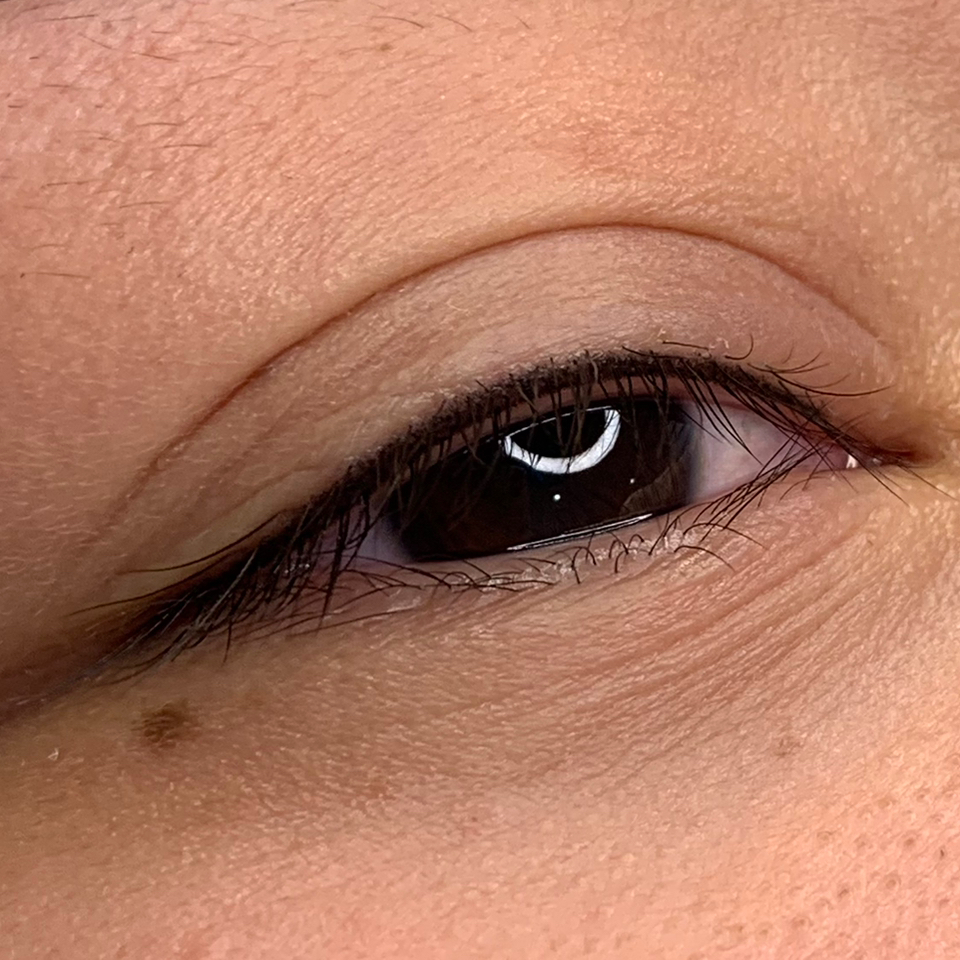 Межресничка