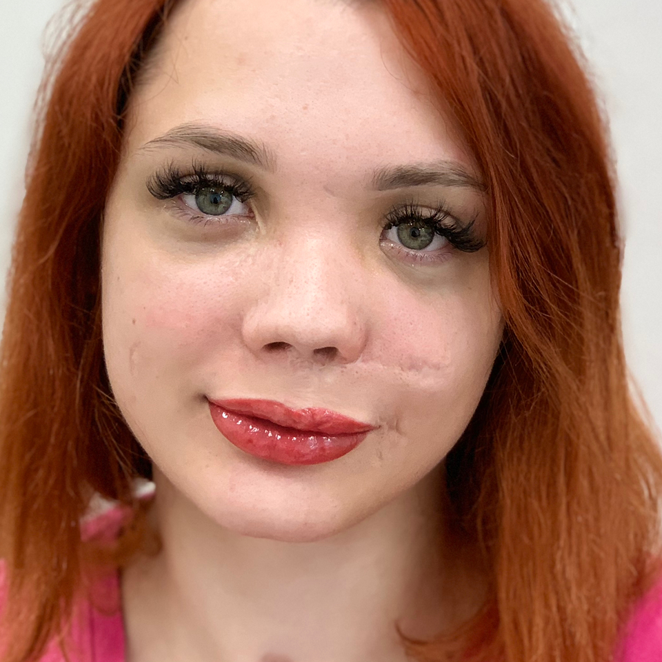 Камуфляж шрамов, дефектов, Рубцов