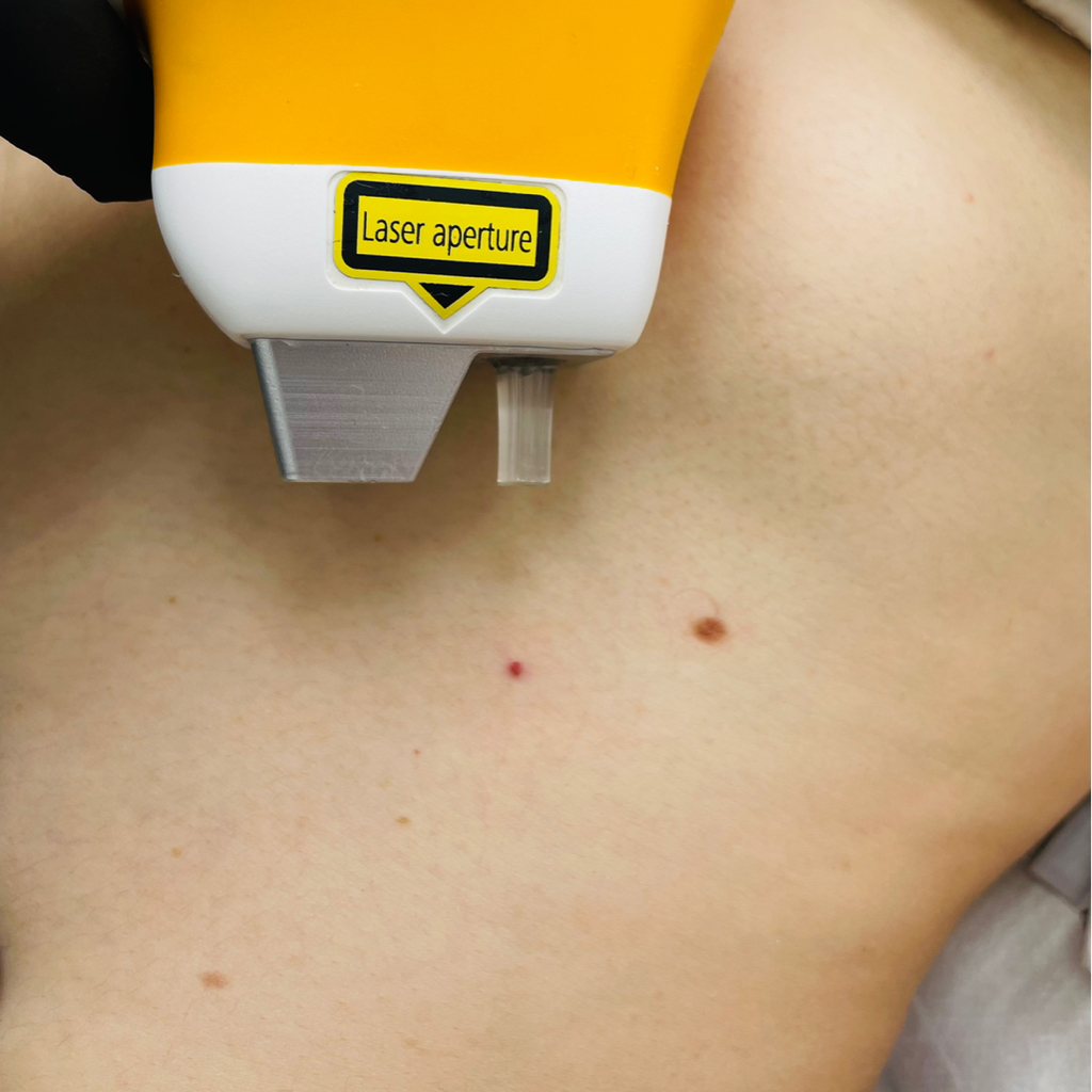 Удаление лазером ангиом