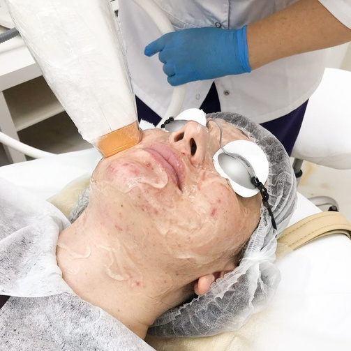 Лазерное лечение акне на лице