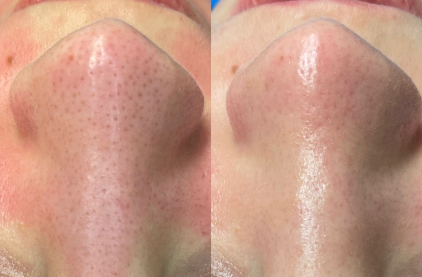 GLOW-EFFECT: глубокое очищение/
Naha sügavpuhastus