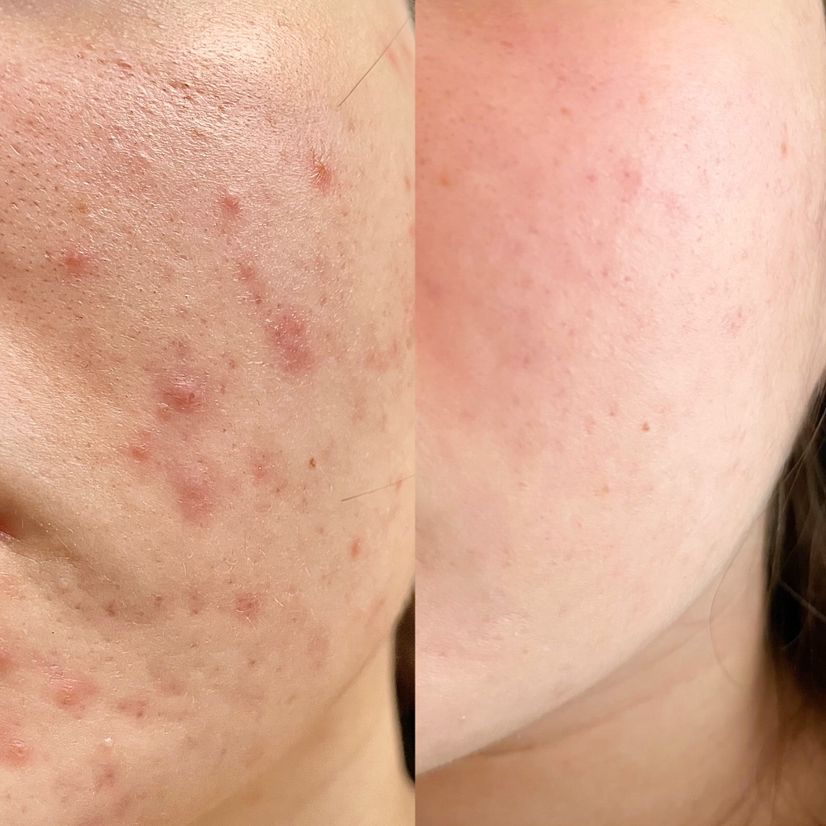 АНТИ-АКНЕ ТЕРАПИЯ: чистая кожа/ ANTI-ACNE teraapia