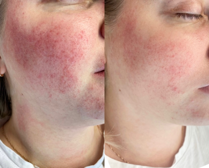Лечение купероза/розацеа