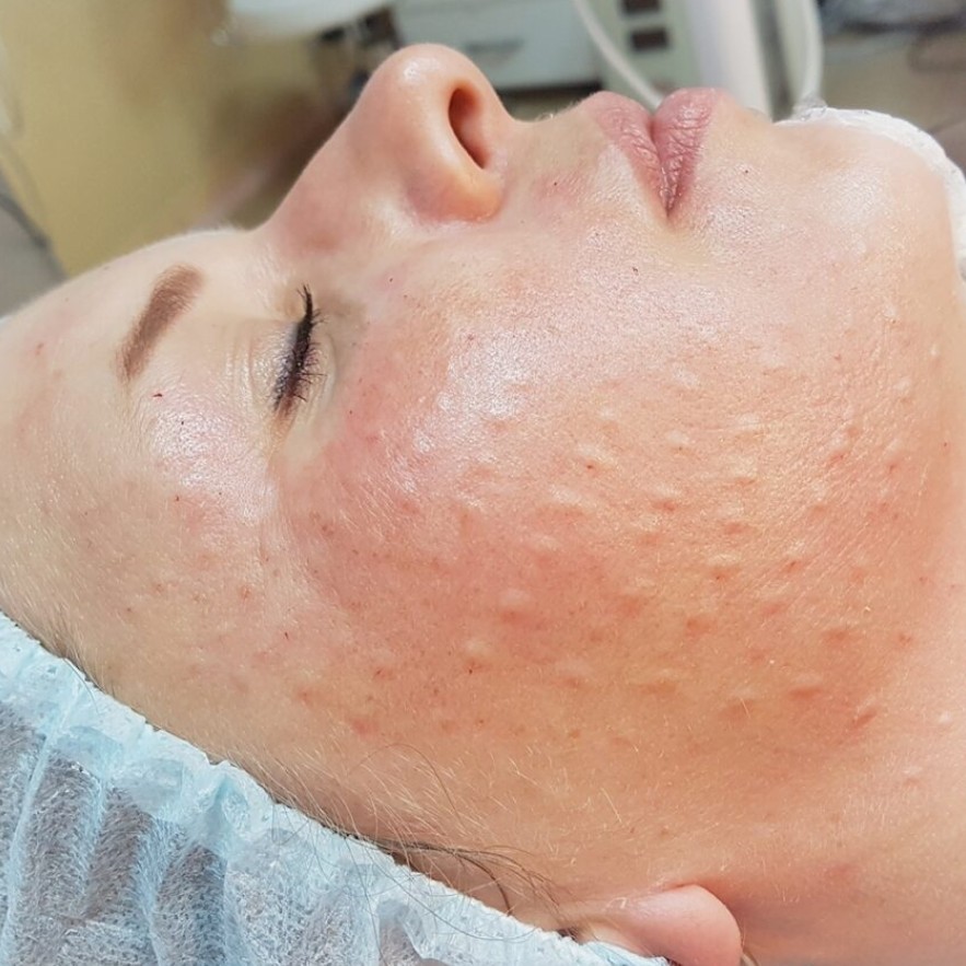 Биоревитализация лица