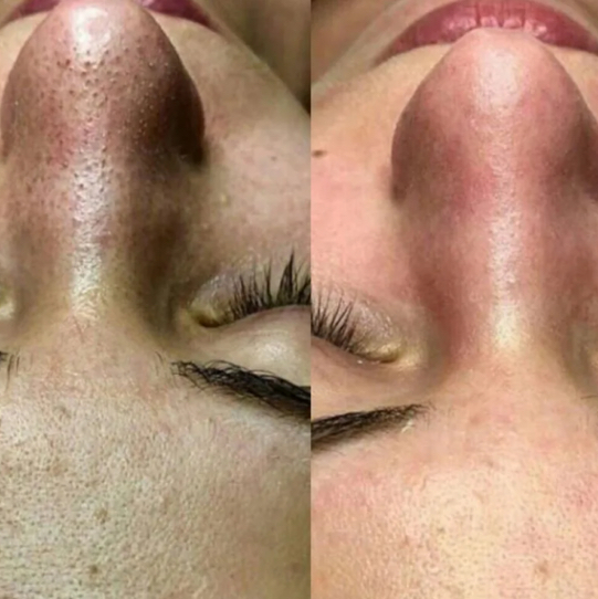 Чистка лица комбинированная