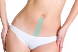 ЛЭ: белая линия живота