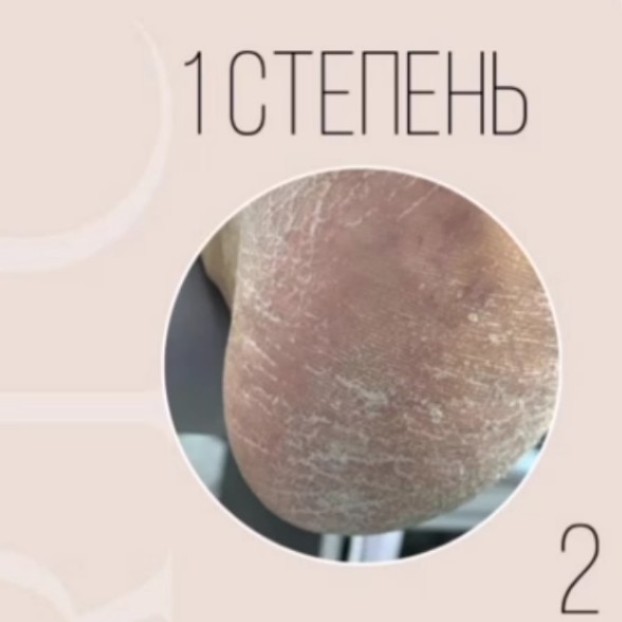 обработка стоп степень 1