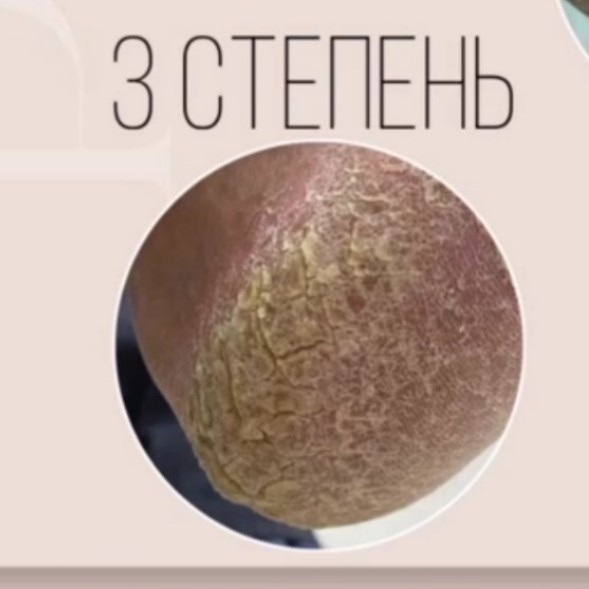 обработка стоп степень 3