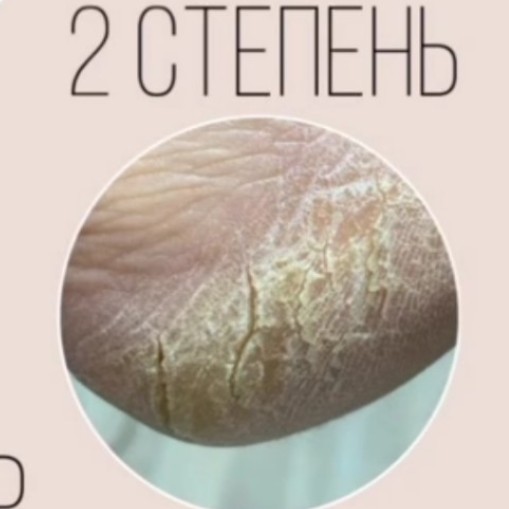 обработка стоп  степень 2
