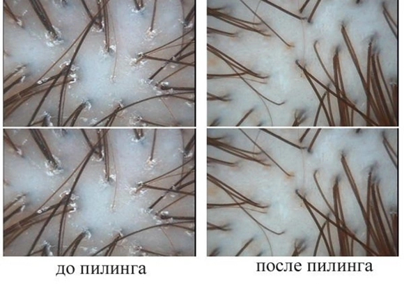 Пилинг кожи головы