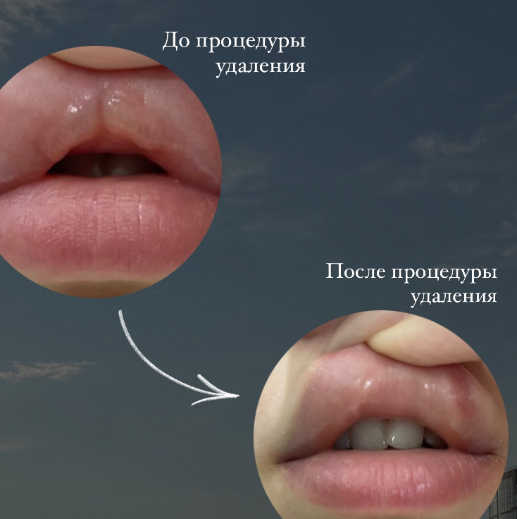 Удаление губ