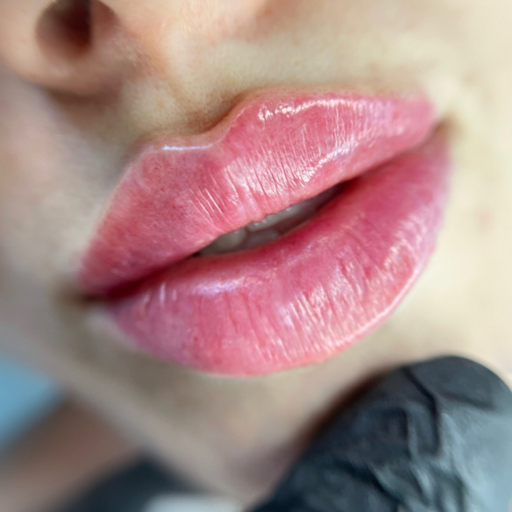 Контурная пластика губ ( увеличение)