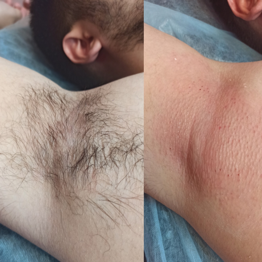 Подмышечные впадины муж.