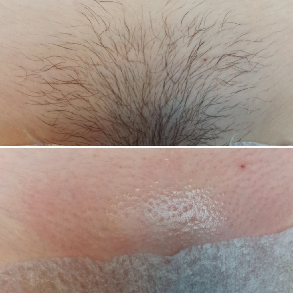 Бикини глубокое