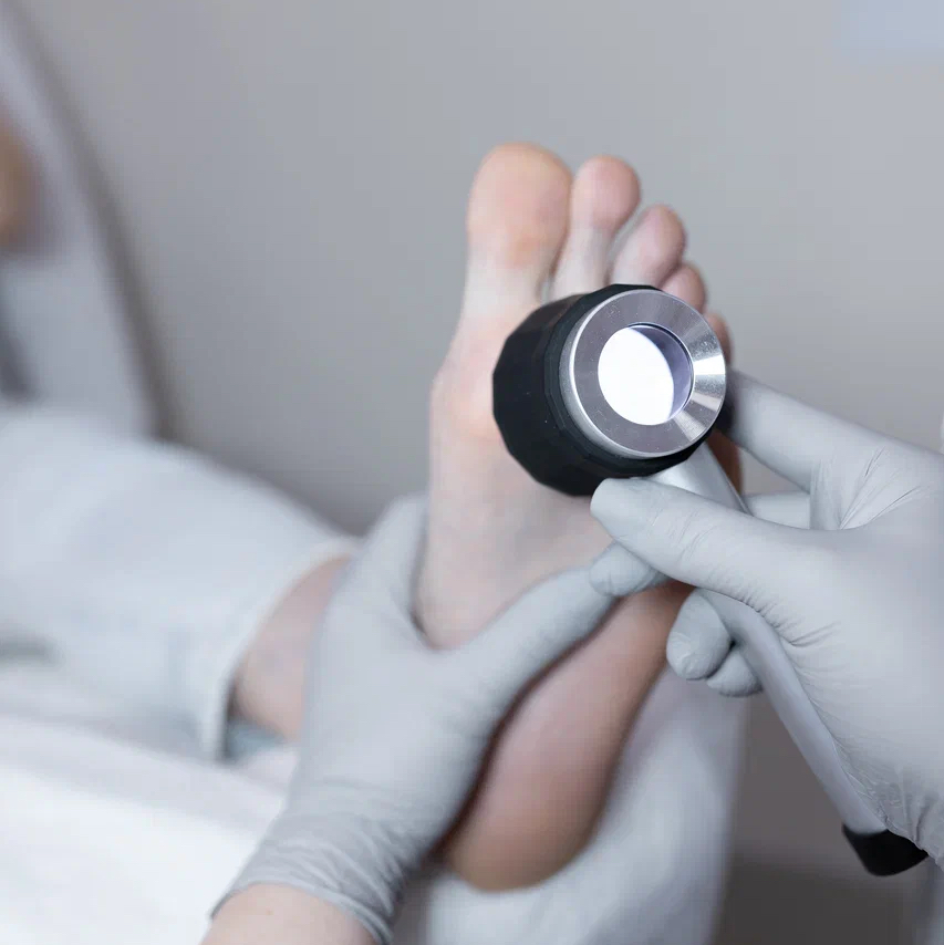 Повторная обработка бородавки