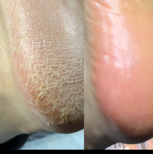 Обработка стоп (смарт педикюр )