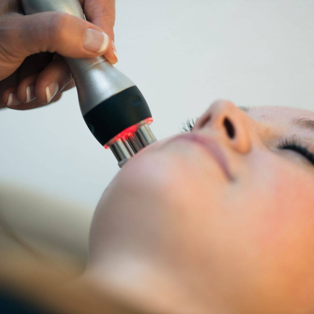 RF-лифтинг лица