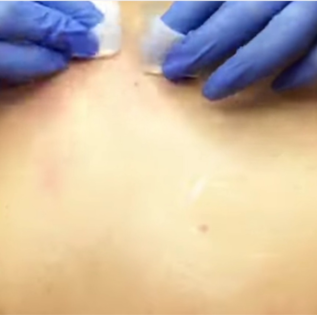 Чистка зоны шеи декольте, или задняя поверхность (шейно-воротниковая зона).