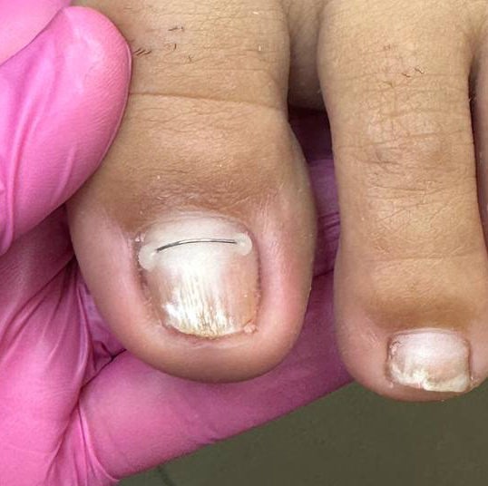 Установка титановой нити.