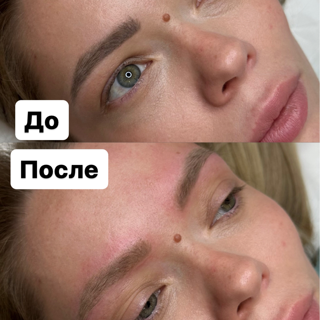 Удаление татуажа бровей
