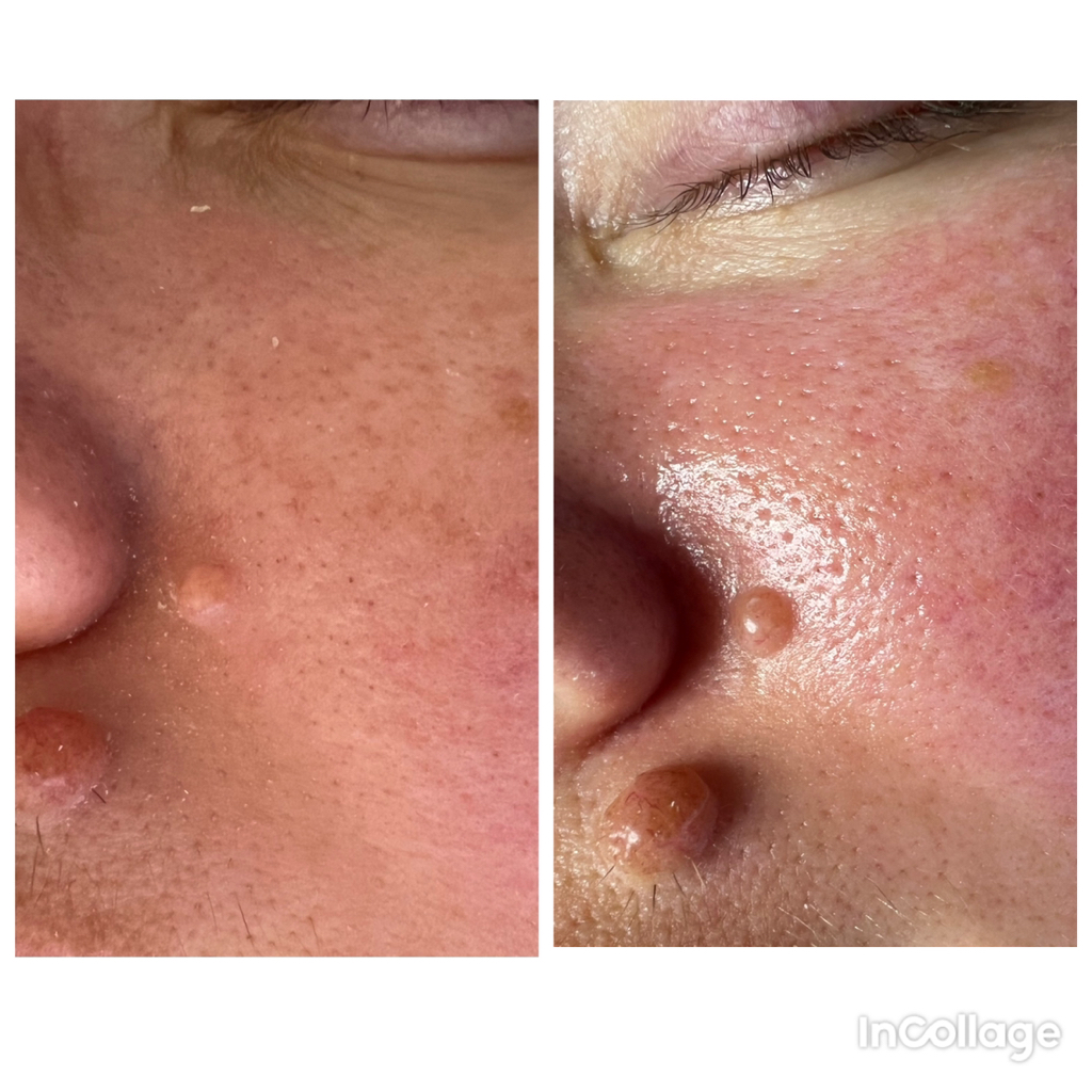 Механическая чистка 1 ст.