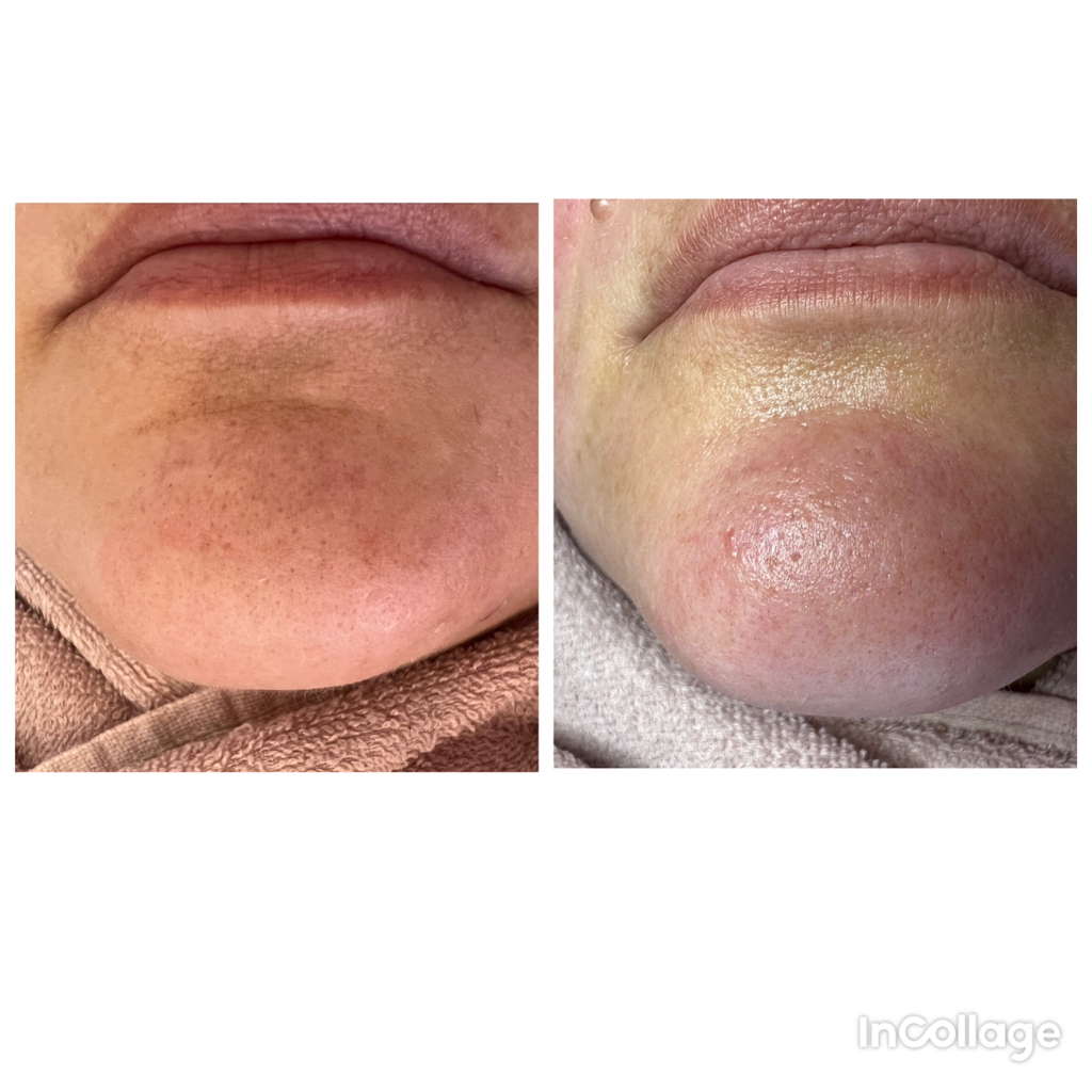 Механическая чистка 2 ст.