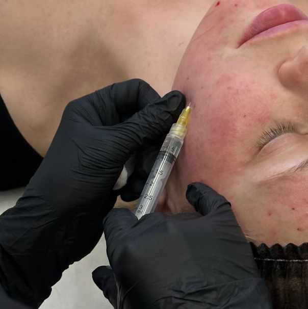 Биоревитализация