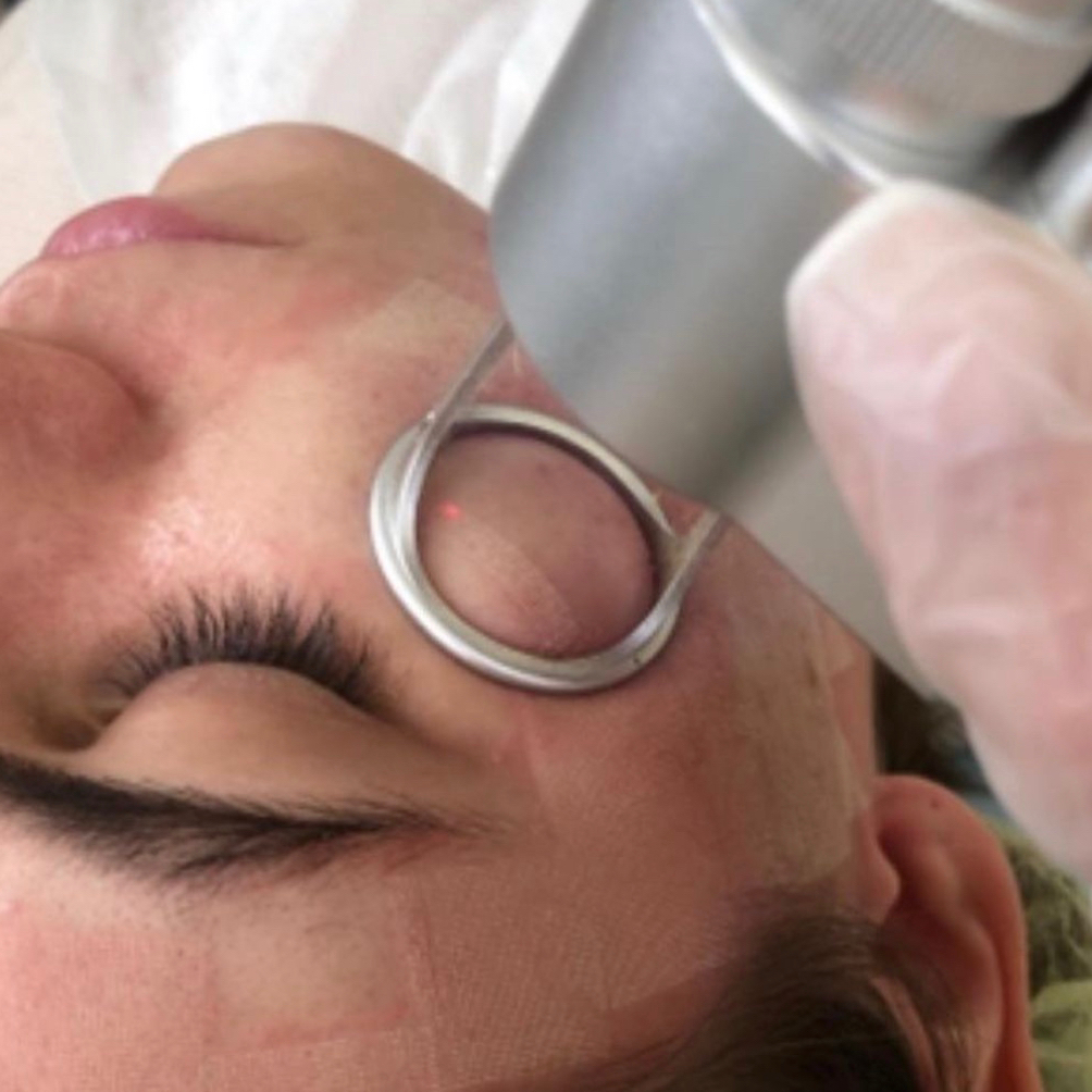 CO2 FRACTIONAL LASER  ( Τοπικά )