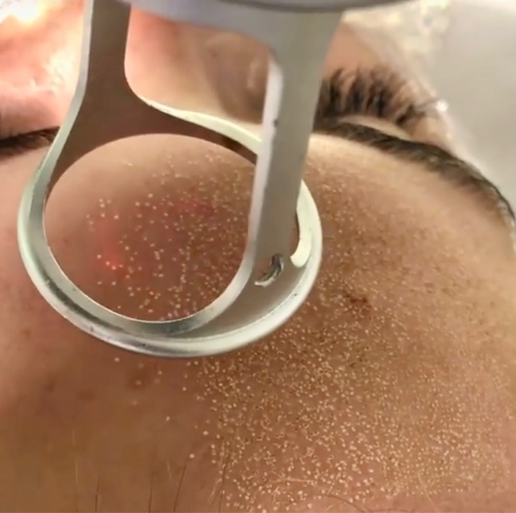 CO2 FRACTIONAL  ALL FACE LIFTING( Πρόσωπο)