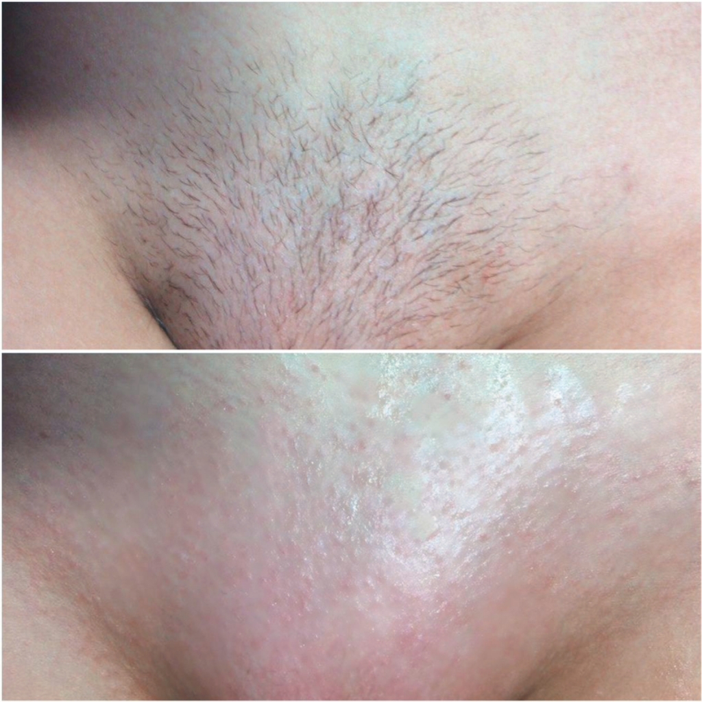 Глубокое бикини