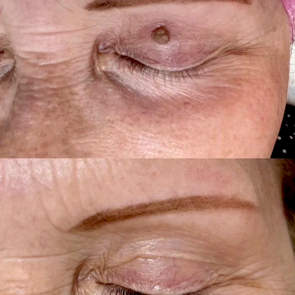 CO2 REMOVAL  :  MOLE,   PIGMENT SPOT,   PAPILLOMA . (1 piece)