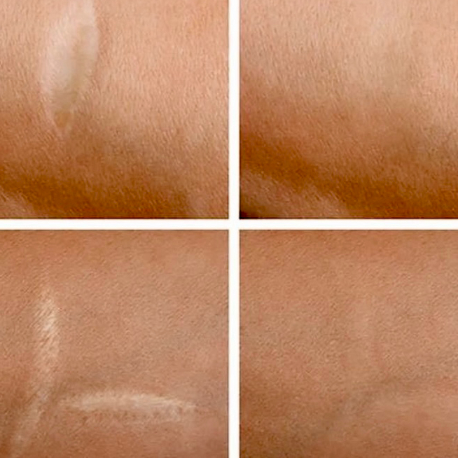 CO2 REMOVAL;  SCARS,  STRETCH MARKS  1 zone   (αφαίρεση ουλών, ραγάδων)