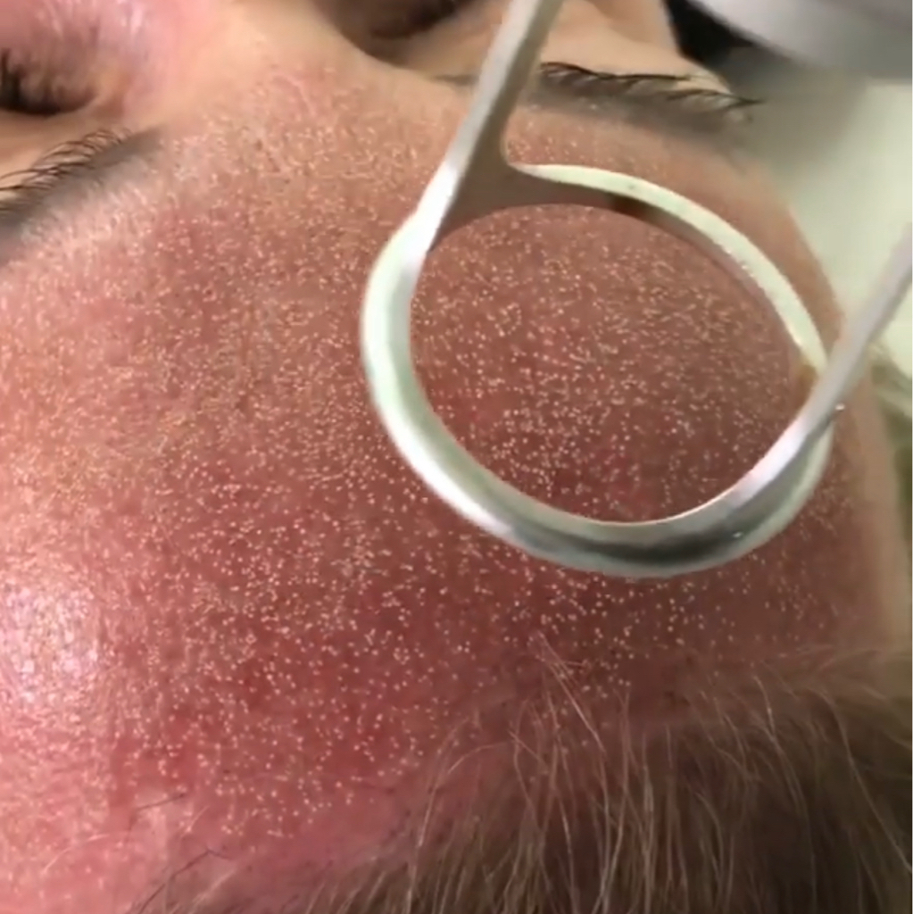 CO2 -COOL PEEL   LASER  RESURFACING      MINI LIFTING   \Face+Neck+Necklace \