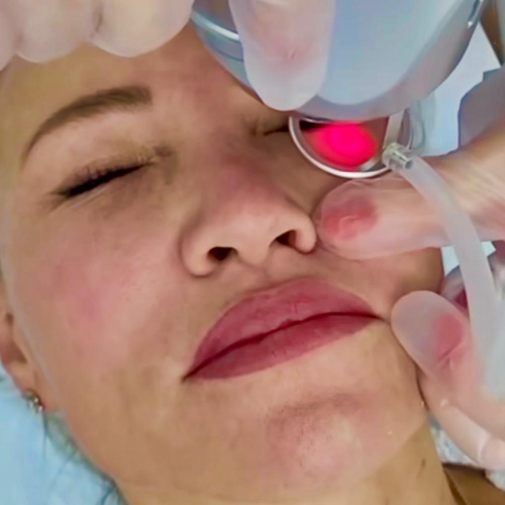 CO2 - EYES LIFTING     NON- SURGICAL BLEPHAROPLASTY    /Μη χειρουργική βλεφαροπλαστική/ 3 επανάληψης (60 € Συνεδρία)