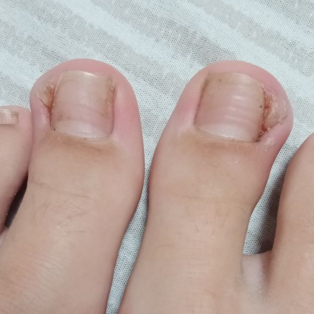 Консультация + работа с вросшим ногтем (первое посещение)