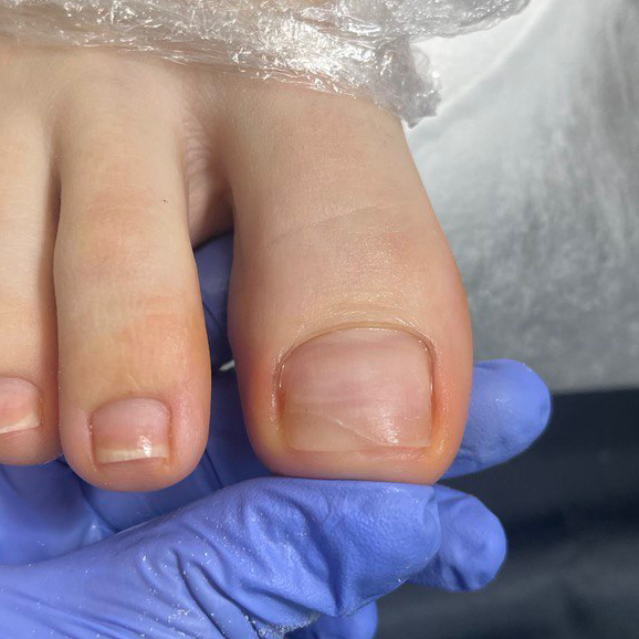 Протезирование ногтевой пластины