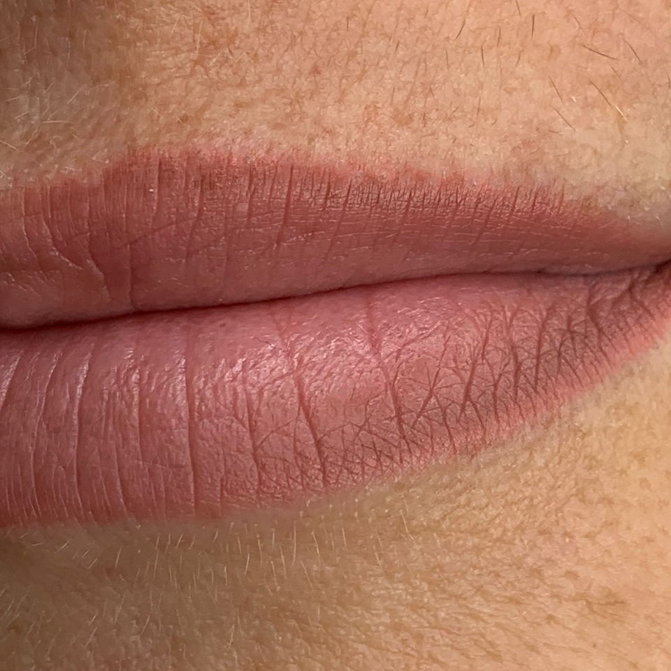 Удаление ремувером кислотным