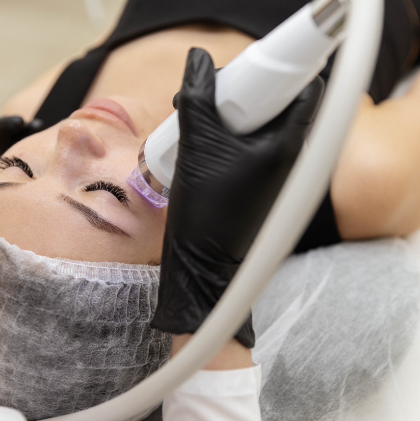 Микроигольчатый RF: лицо полностью